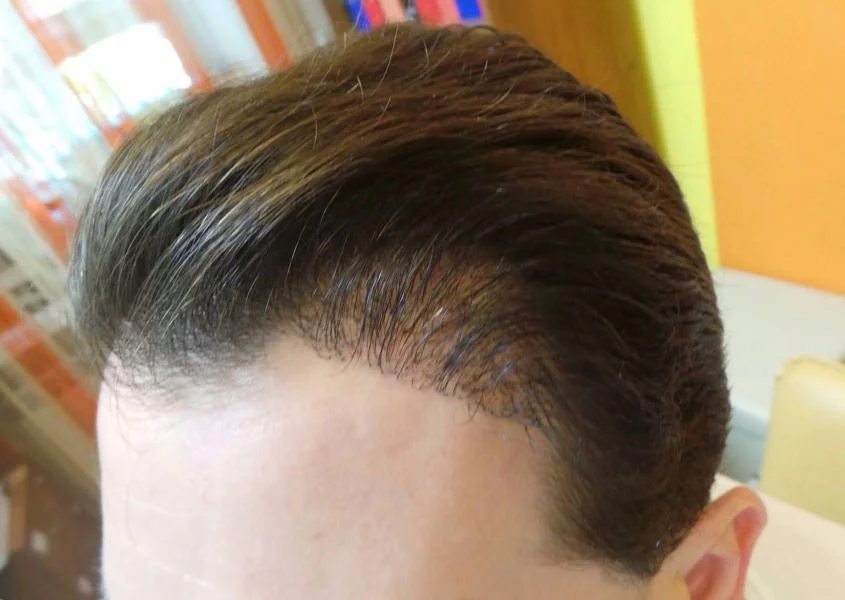 Пересадка волос в клинике доктора Шолохова