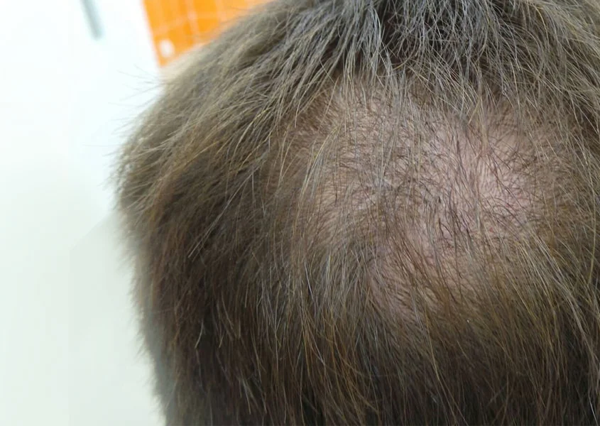 Пересадка волос в клинике доктора Шолохова