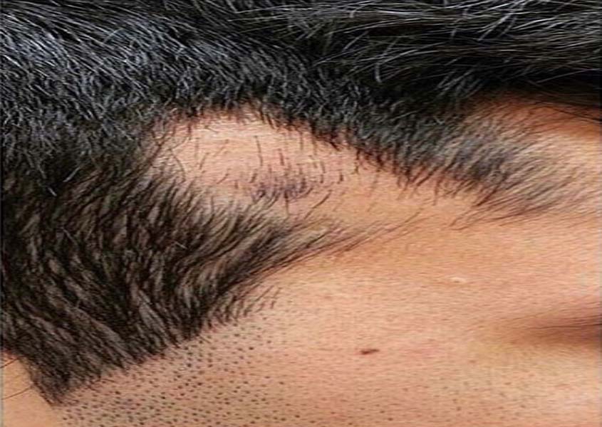 Пересадка волос в область рубцов
