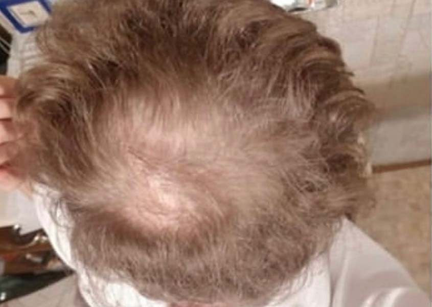 Пересадка волос на голове